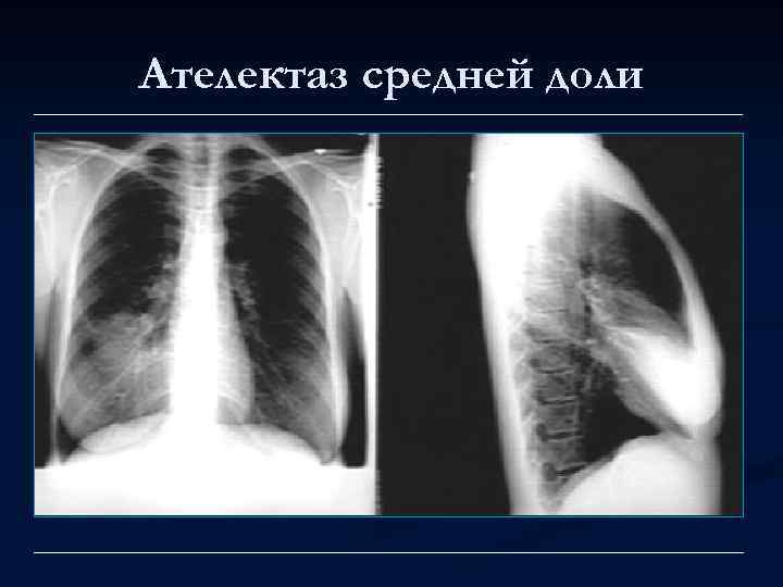Ателектаз средней доли 