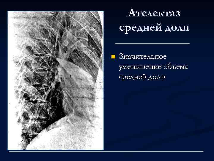 Ателектаз средней доли n Значительное уменьшение объема средней доли 