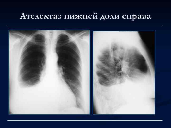 Ателектаз нижней доли справа 