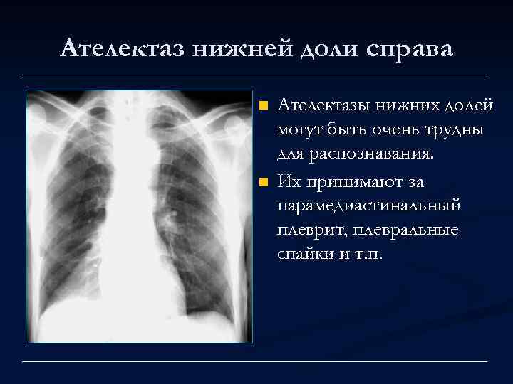 Ателектаз нижней доли справа n n Ателектазы нижних долей могут быть очень трудны для