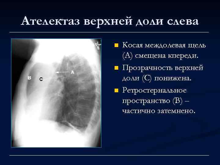 Ателектаз верхней доли слева n n n Косая междолевая щель (А) смещена кпереди. Прозрачность