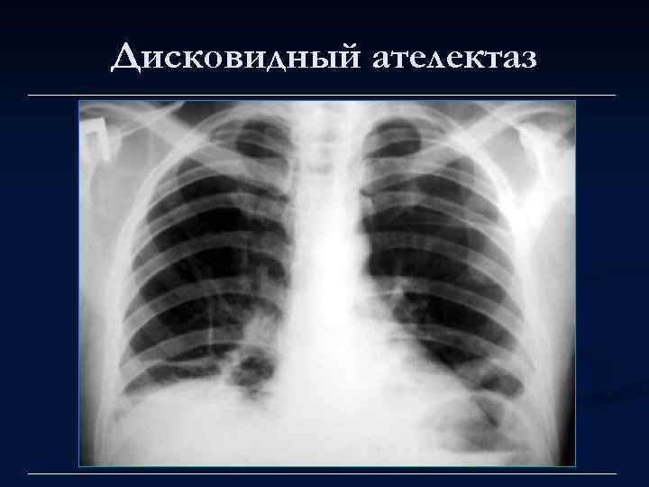 Дисковидный ателектаз 