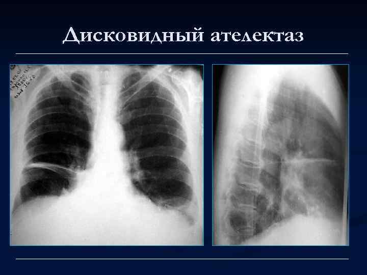 Дисковидный ателектаз 