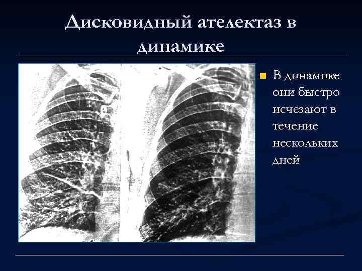 Дисковидный ателектаз в динамике n В динамике они быстро исчезают в течение нескольких дней