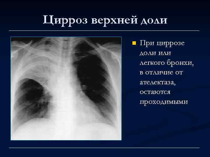 Цирроз верхней доли n При циррозе доли или легкого бронхи, в отличие от ателектаза,