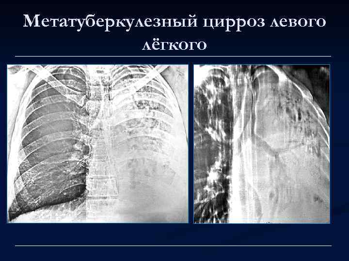 Метатуберкулезный цирроз левого лёгкого 