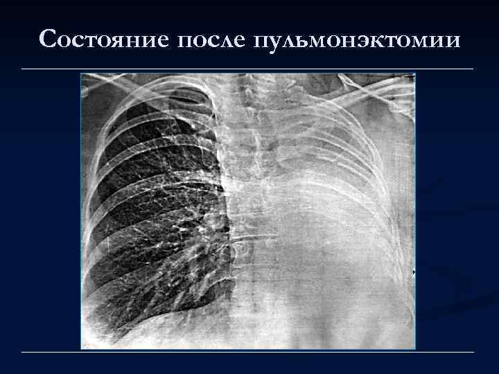 Состояние после пульмонэктомии 