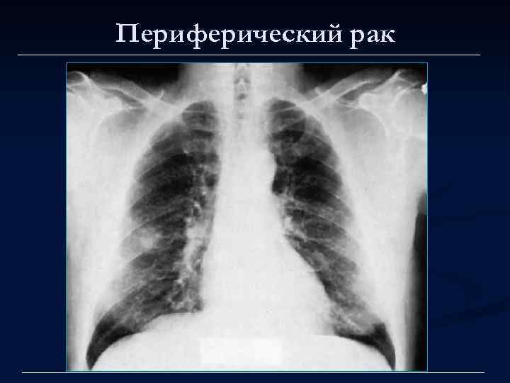 Периферический рак 