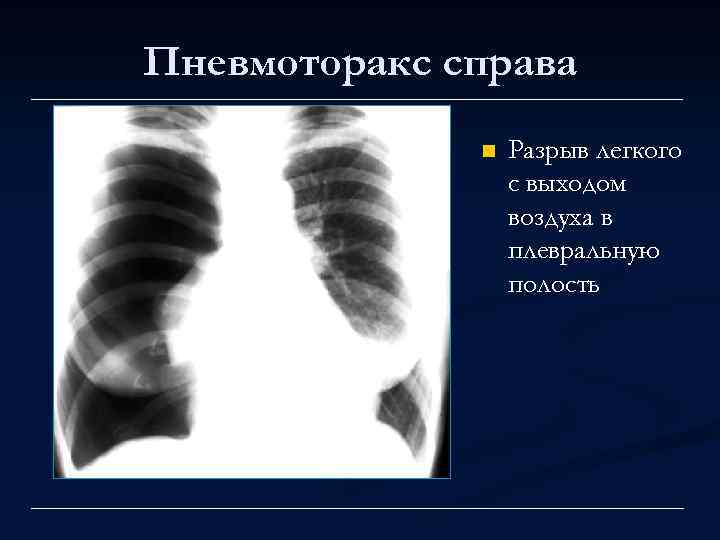Пневмоторакс справа n Разрыв легкого с выходом воздуха в плевральную полость 