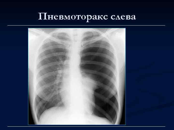 Пневмоторакс слева 
