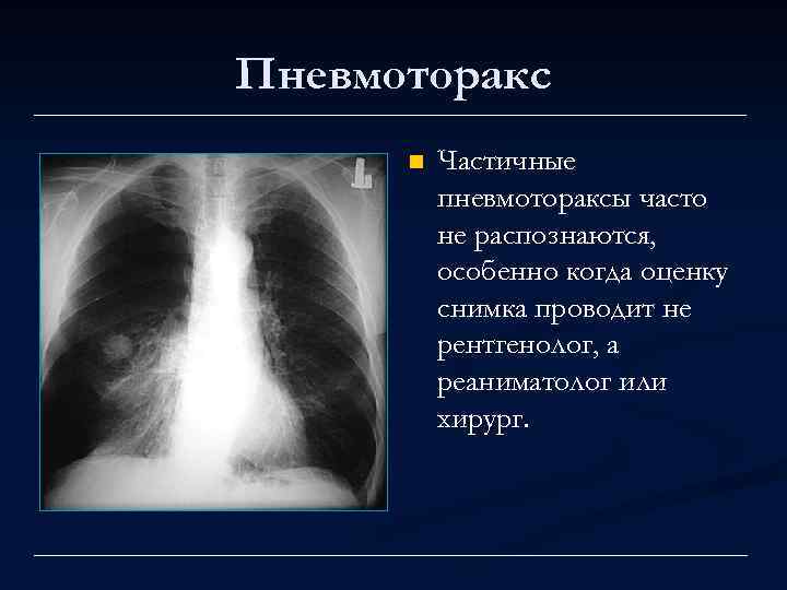 Пневмоторакс n Частичные пневмотораксы часто не распознаются, особенно когда оценку снимка проводит не рентгенолог,