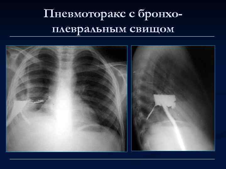 Пневмоторакс с бронхоплевральным свищом 