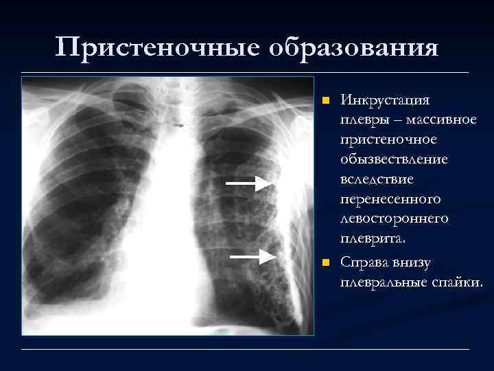 Пристеночные образования n n Инкрустация плевры – массивное пристеночное обызвествление вследствие перенесенного левостороннего плеврита.
