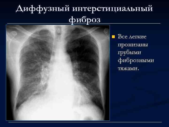 Диффузный интерстициальный фиброз n Все легкие пронизаны грубыми фиброзными тяжами. 