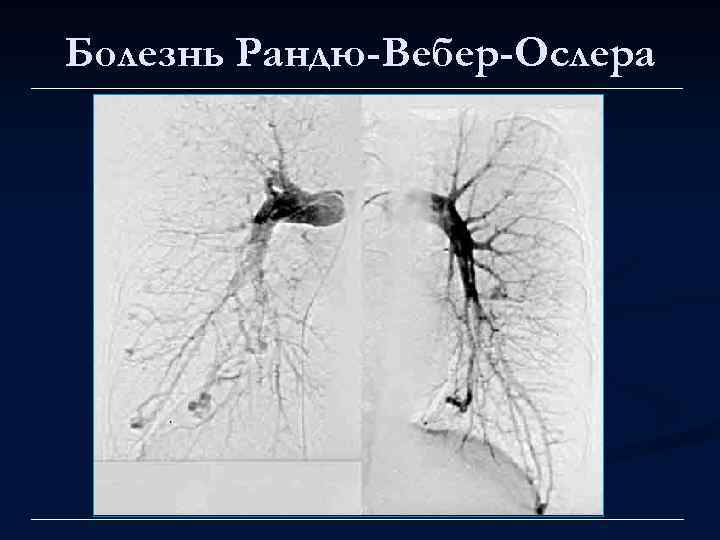 Болезнь Рандю-Вебер-Ослера 