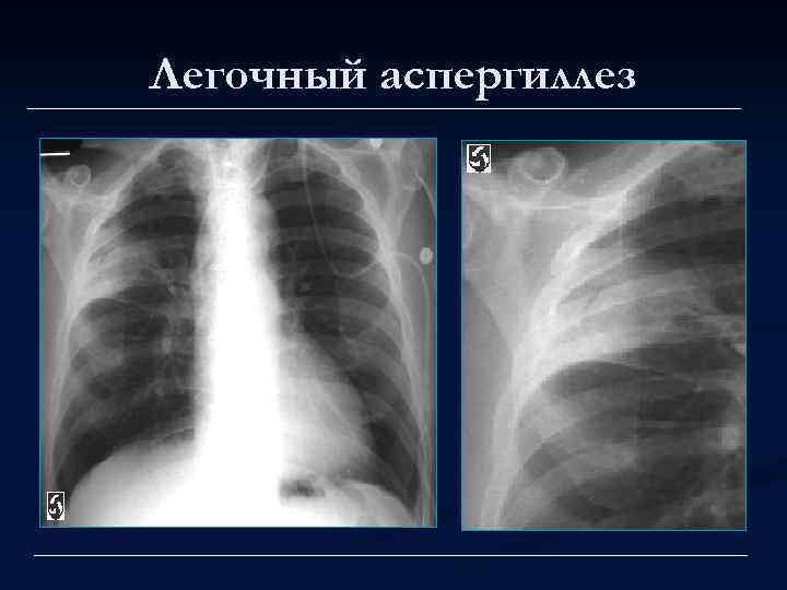 Легочный аспергиллез 