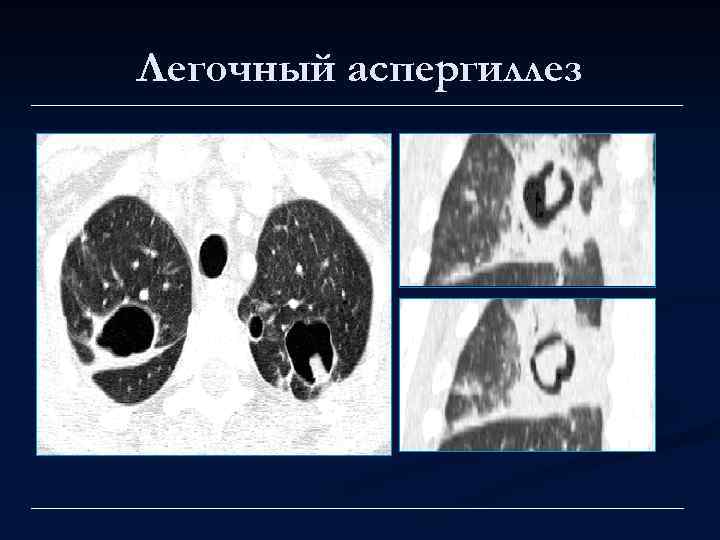 Легочный аспергиллез 