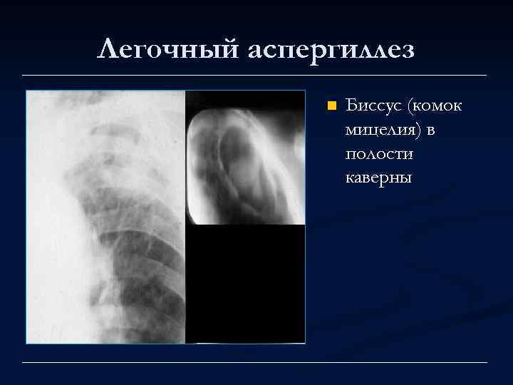 Легочный аспергиллез n Биссус (комок мицелия) в полости каверны 