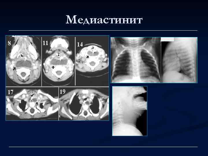 Медиастинит 