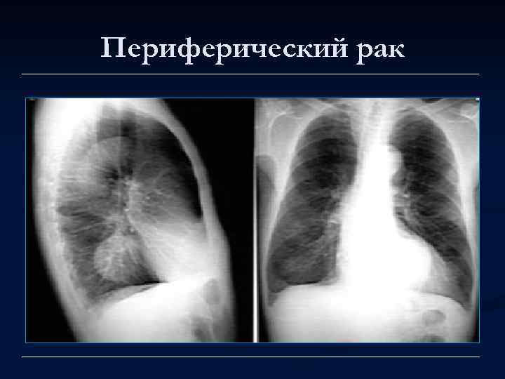 Периферический рак 