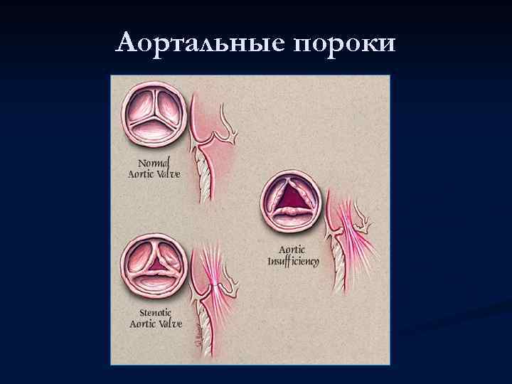 Аортальные пороки 
