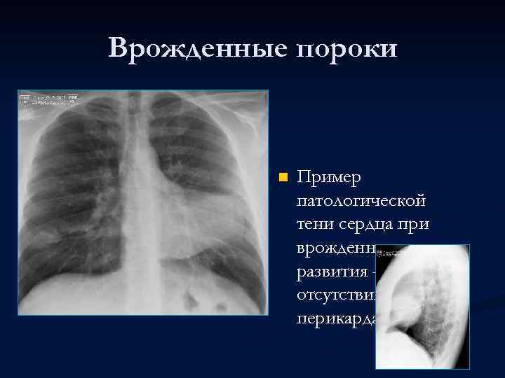 Врожденные пороки n Пример патологической тени сердца при врожденном пороке развития – отсутствии перикарда