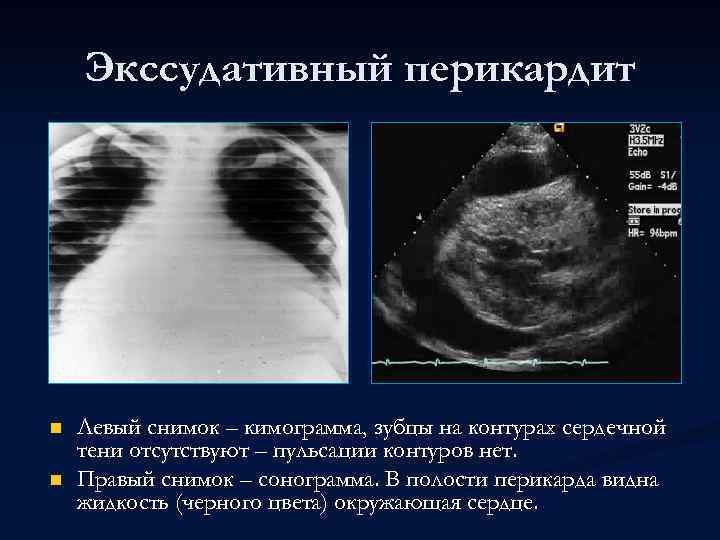 Экссудативный перикардит n n Левый снимок – кимограмма, зубцы на контурах сердечной тени отсутствуют