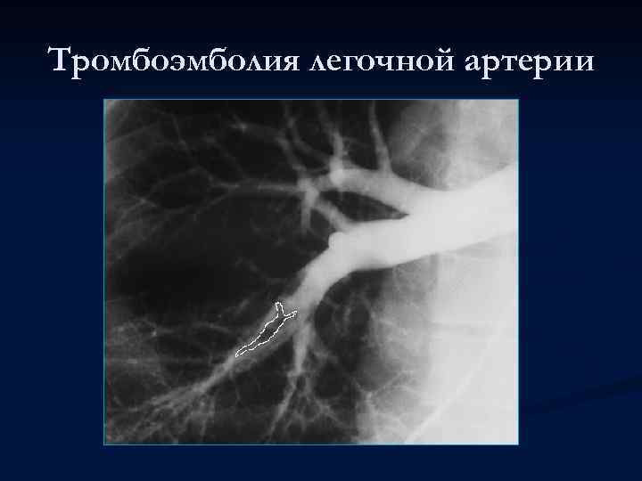 Тромбоэмболия легочной артерии 