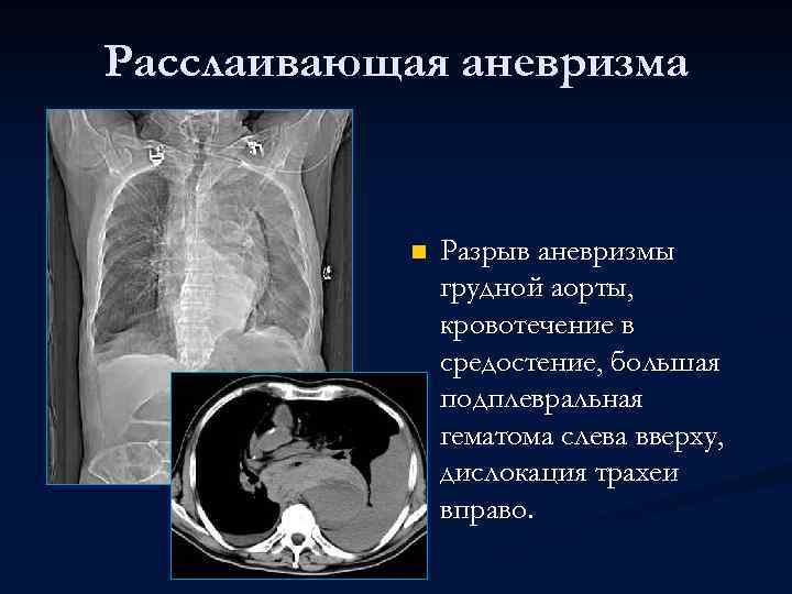 Расслаивающая аневризма n Разрыв аневризмы грудной аорты, кровотечение в средостение, большая подплевральная гематома слева