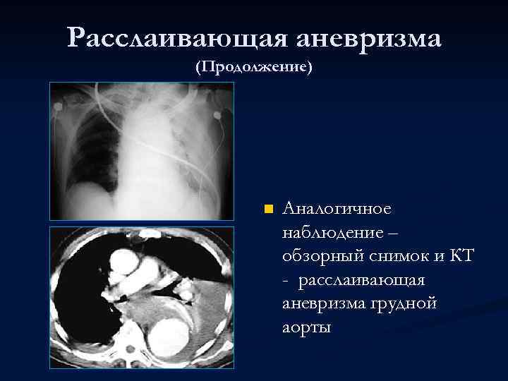 Расслаивающая аневризма (Продолжение) n Аналогичное наблюдение – обзорный снимок и КТ - расслаивающая аневризма