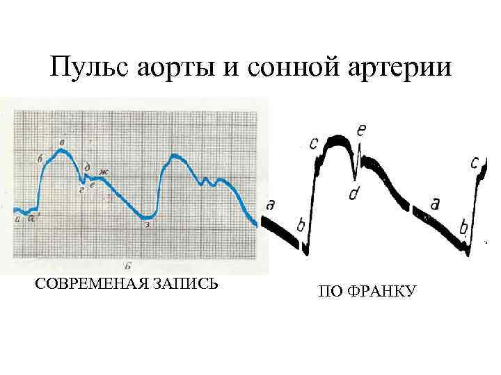 Пульс аорты и сонной артерии СОВРЕМЕНАЯ ЗАПИСЬ ПО ФРАНКУ 