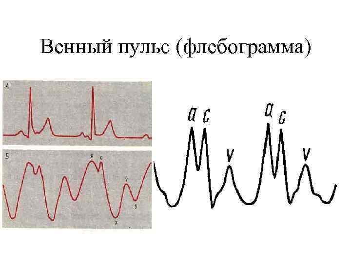 Венный пульс (флебограмма) 