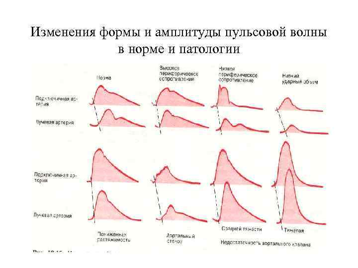 Изменения формы и амплитуды пульсовой волны в норме и патологии 