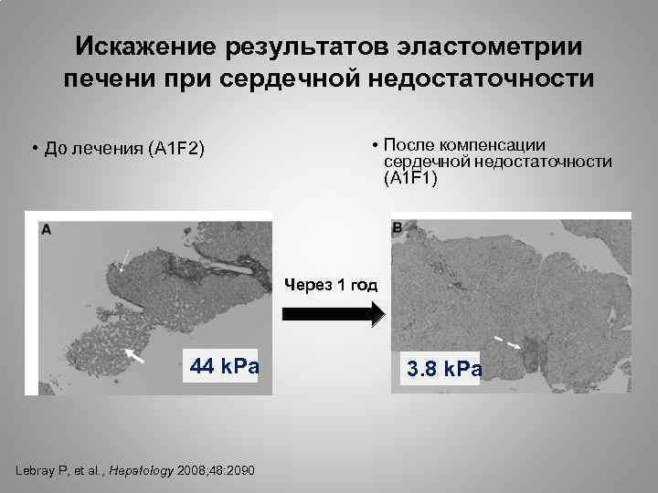 Искажение результатов эластометрии печени при сердечной недостаточности • До лечения (A 1 F 2)