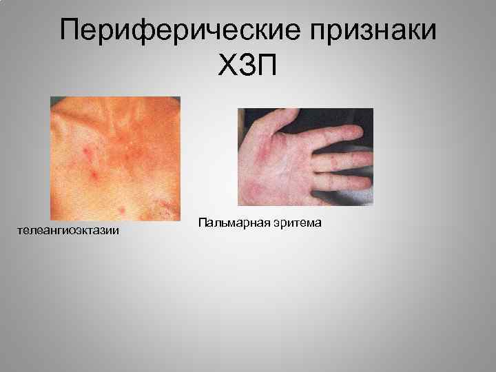 Voprosy Diagnostiki I Terapii Hronicheskih Zabolevanij Pecheni D