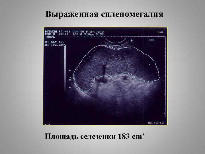 Выраженная спленомегалия Площадь селезенки 183 cm² 