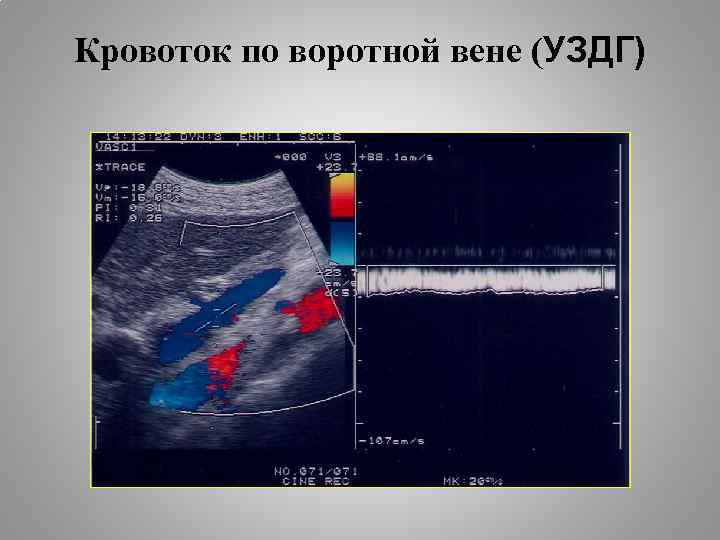 Кровоток по воротной вене (УЗДГ) 