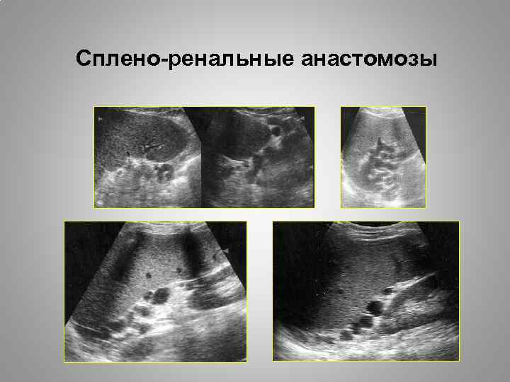 Сплено-ренальные анастомозы 