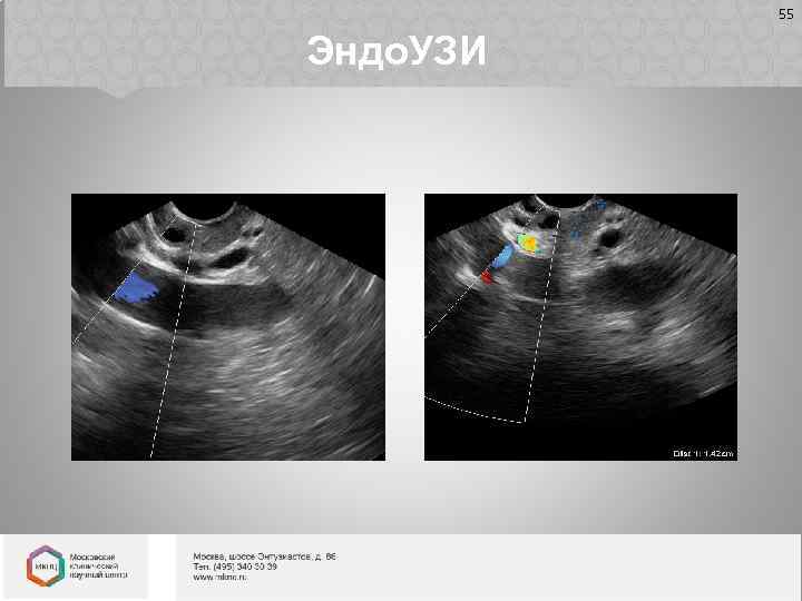 55 Эндо. УЗИ 