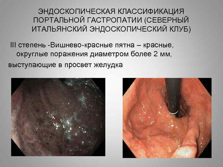 ЭНДОСКОПИЧЕСКАЯ КЛАССИФИКАЦИЯ ПОРТАЛЬНОЙ ГАСТРОПАТИИ (СЕВЕРНЫЙ ИТАЛЬЯНСКИЙ ЭНДОСКОПИЧЕСКИЙ КЛУБ) III степень -Вишнево-красные пятна – красные,