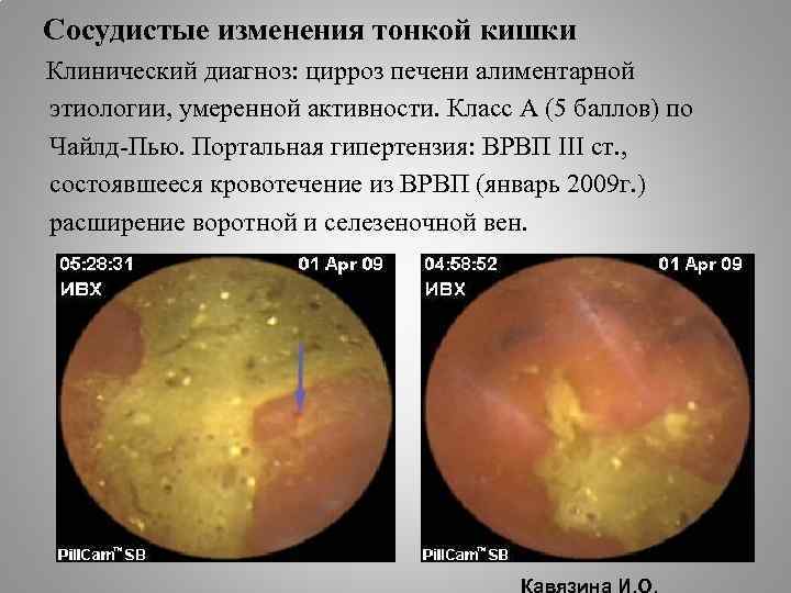 Сосудистые изменения тонкой кишки Клинический диагноз: цирроз печени алиментарной этиологии, умеренной активности. Класс А