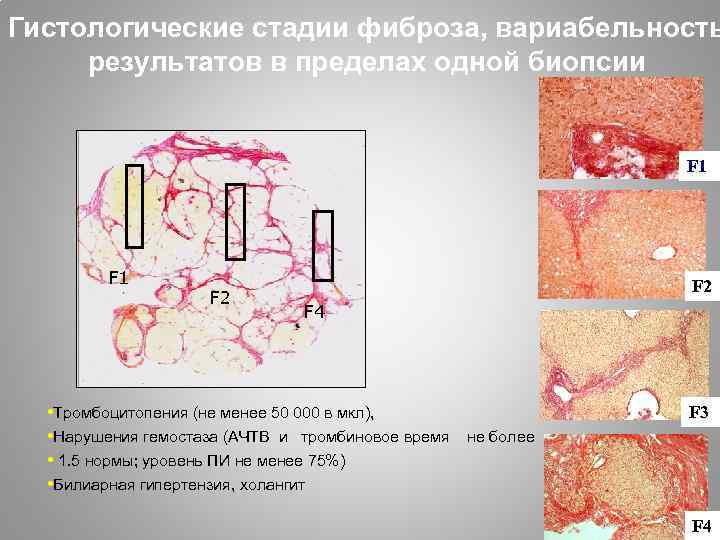 Гистологические стадии фиброза, вариабельность результатов в пределах одной биопсии F 1 F 2 F