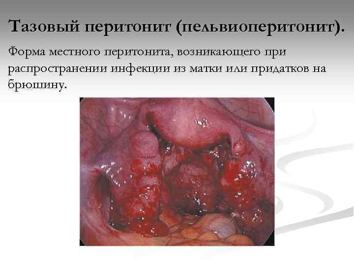 Тазовый перитонит (пельвиоперитонит). Форма местного перитонита, возникающего при распространении инфекции из матки или придатков