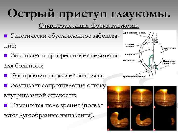 Острый приступ глаукомы. Открытоугольная форма глаукомы. n Генетически обусловленное заболевание; n Возникает и прогрессирует