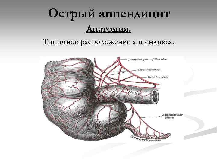 Острый аппендицит Анатомия. Типичное расположение аппендикса. 