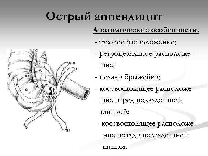 Острый аппендицит Анатомические особенности. - тазовое расположение; - ретроцекальное расположение; - позади брыжейки; -