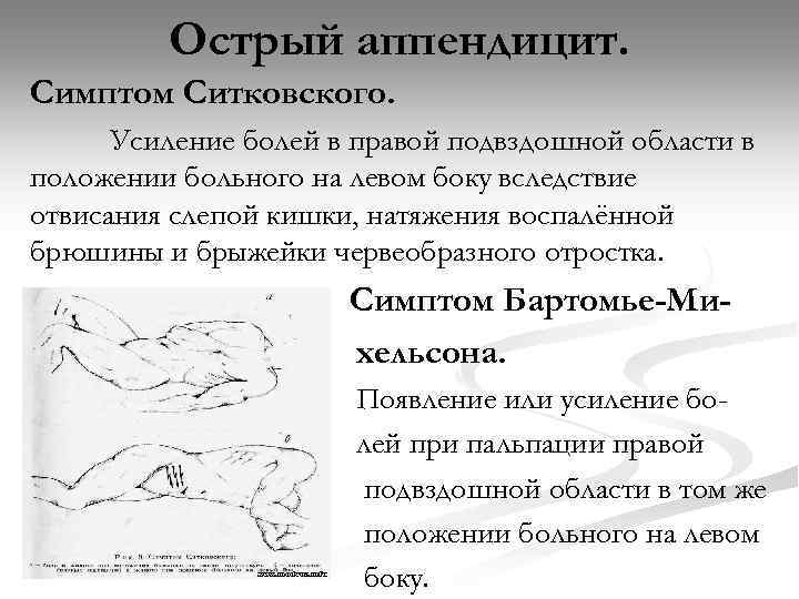 Острый аппендицит. Симптом Ситковского. Усиление болей в правой подвздошной области в положении больного на