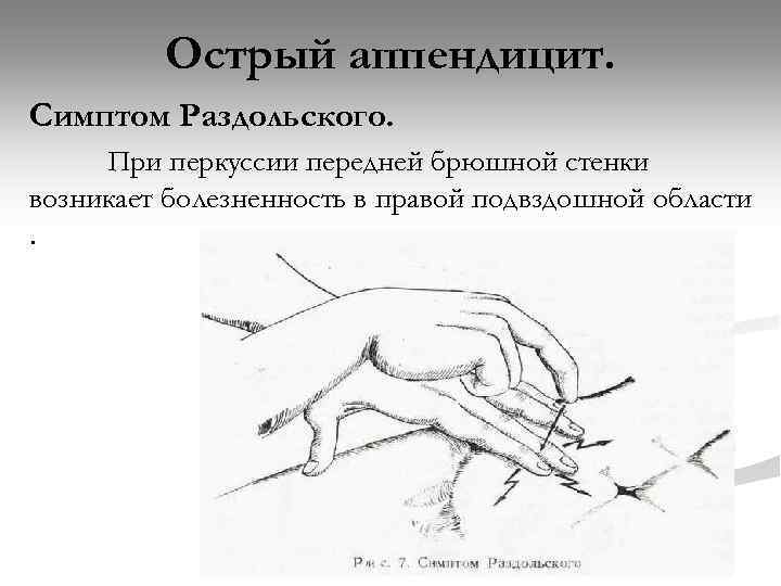 Острый аппендицит. Симптом Раздольского. При перкуссии передней брюшной стенки возникает болезненность в правой подвздошной