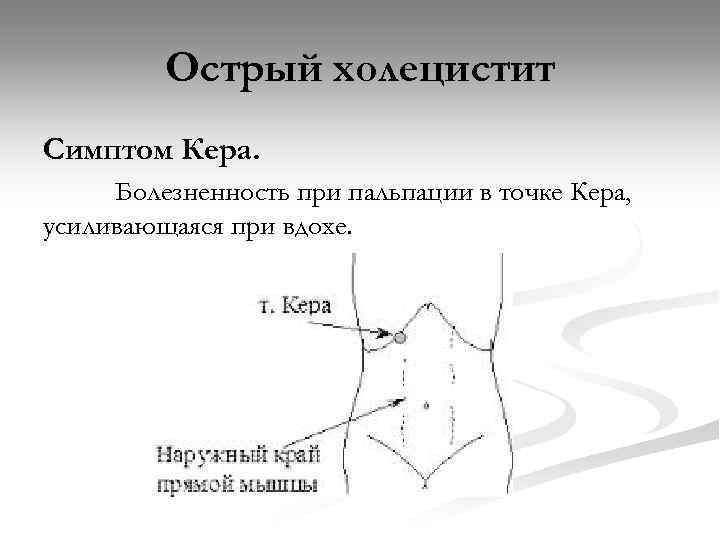 Острый холецистит Симптом Кера. Болезненность при пальпации в точке Кера, усиливающаяся при вдохе. 