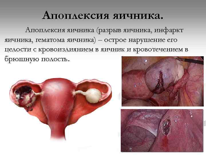 Апоплексия яичника (разрыв яичника, инфаркт яичника, гематома яичника) – острое нарушение его целости с